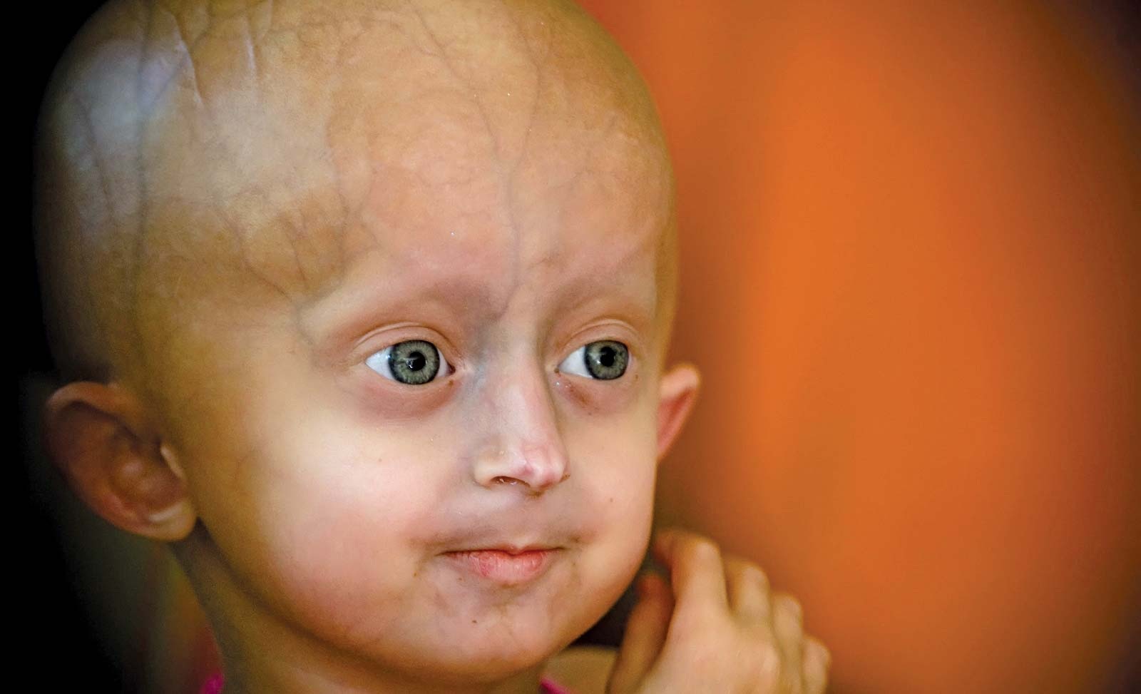 Mengenal Progeria, Penyakit Langka yang Bikin Anak Berfisik Seperti Orang Tua | NNC Netralnews